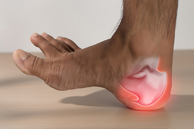 Medical illustration of heel spurs on the underside of a human foot