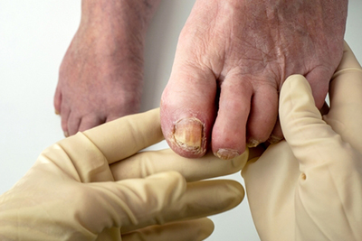 Podiatrist examining a patient’s toenail for fungal infection in a clinic