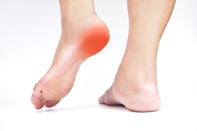 Foot with plantar fasciitis, showing inflamed area highlighted in red on a white background.